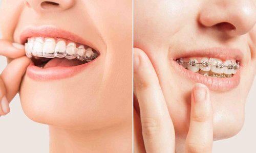 Braces / Aligners treatment in Nagpur