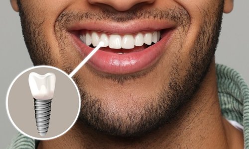 Dental Implant in Nagpur